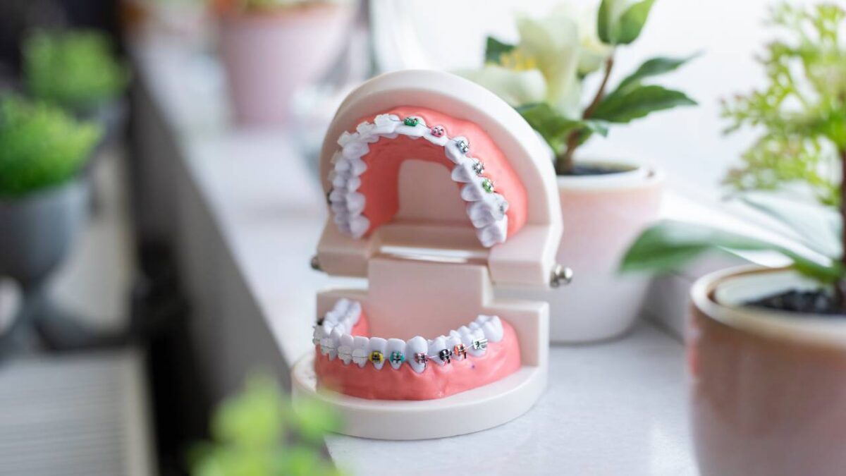 A model of teeth with braces